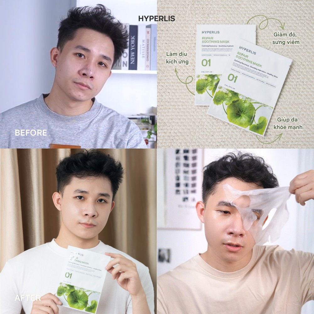 Trước sau dùng mặt nạ HYPERLIS 4